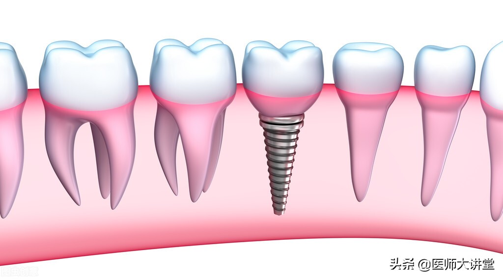 医院种植牙掉了如何赔偿,种植牙齿失败后可以要求赔偿吗