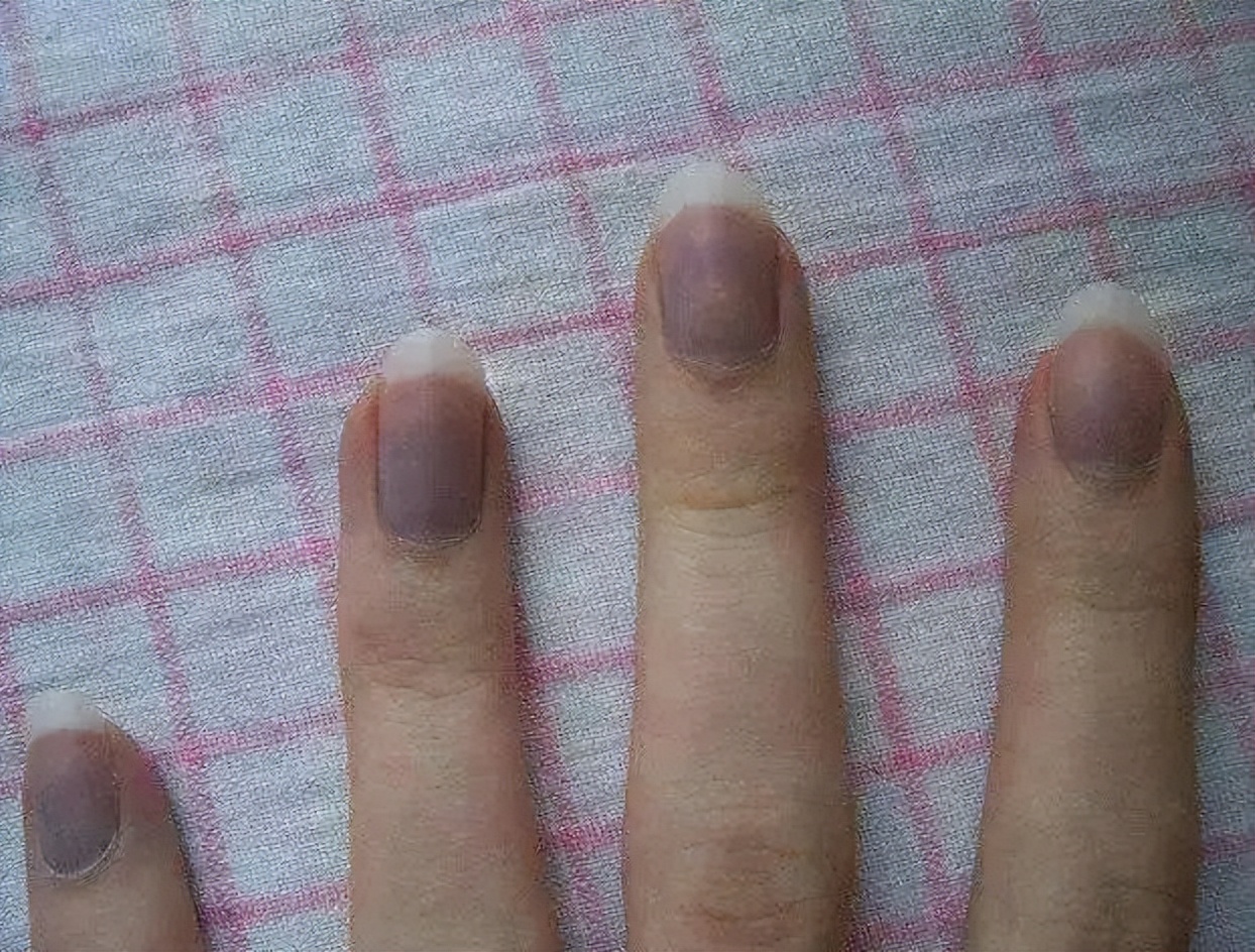 男人身上三处发黑证明肾功能很强,肾功能异常脸色发黑