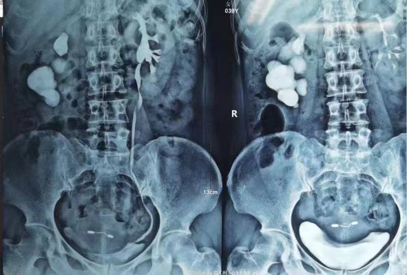 20年拖延不治双肾布满结石长成“珊瑚”！肾脏的通道被满满塞住