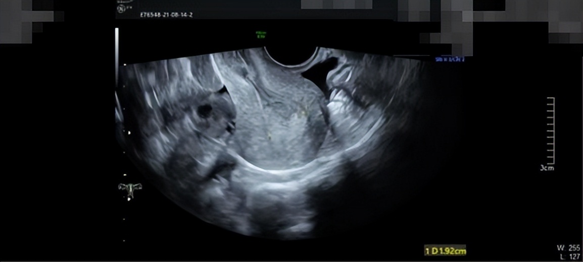 子宫内膜癌的阴道出血症状,子宫内膜癌阴道出血的症状