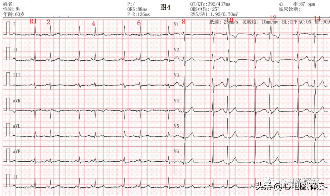 房早和室早怎么分辨,房早和室早的鉴别要点