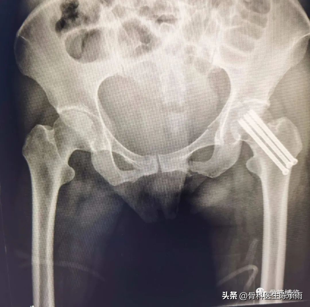 股骨颈闭合复位内固定术后护理,股骨颈骨折闭合复位的技巧