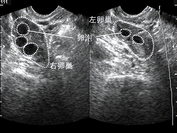 助您好孕——B超监测排卵不可不知道的细节