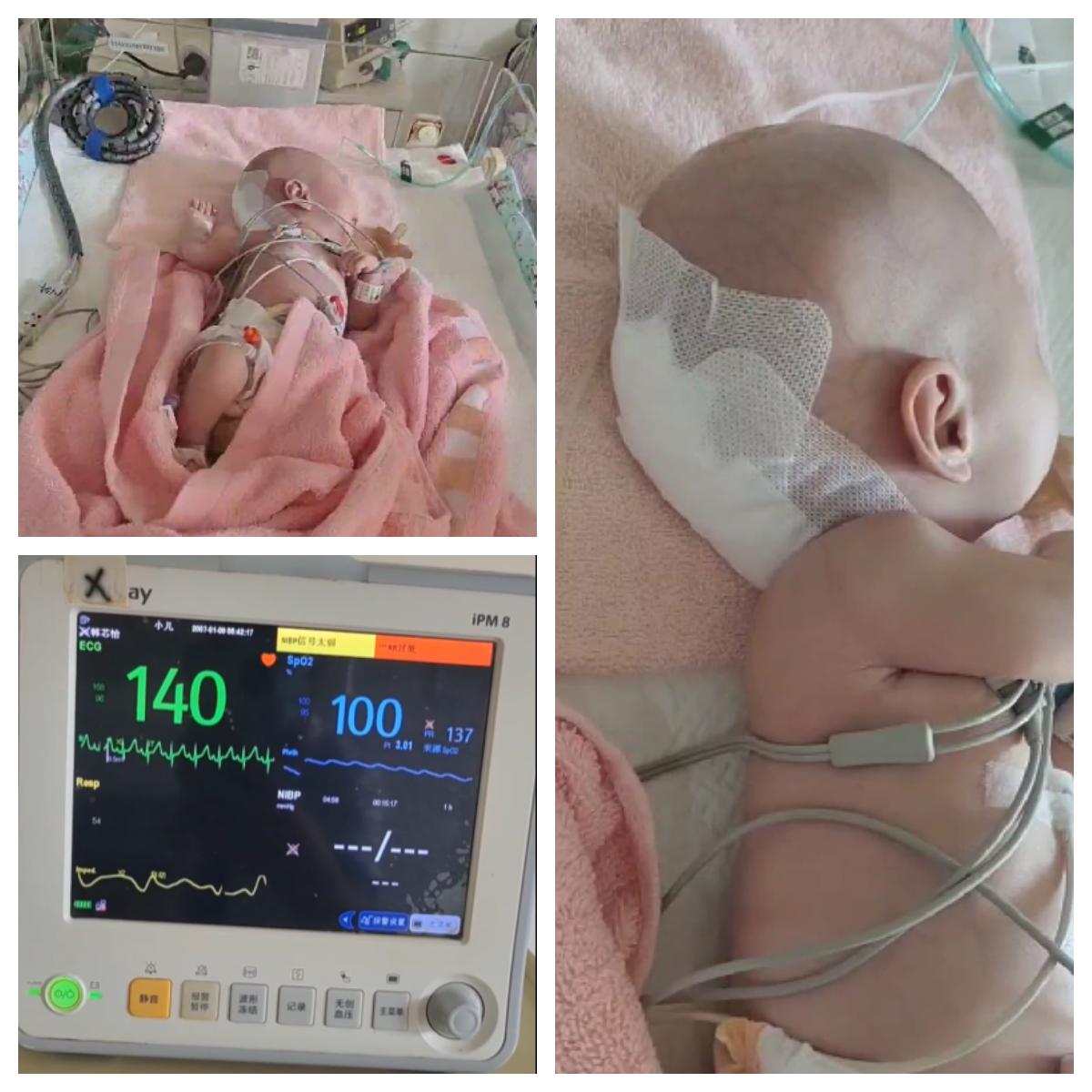 新生儿脑袋有个软软的包,新生儿脑袋上有个包图片