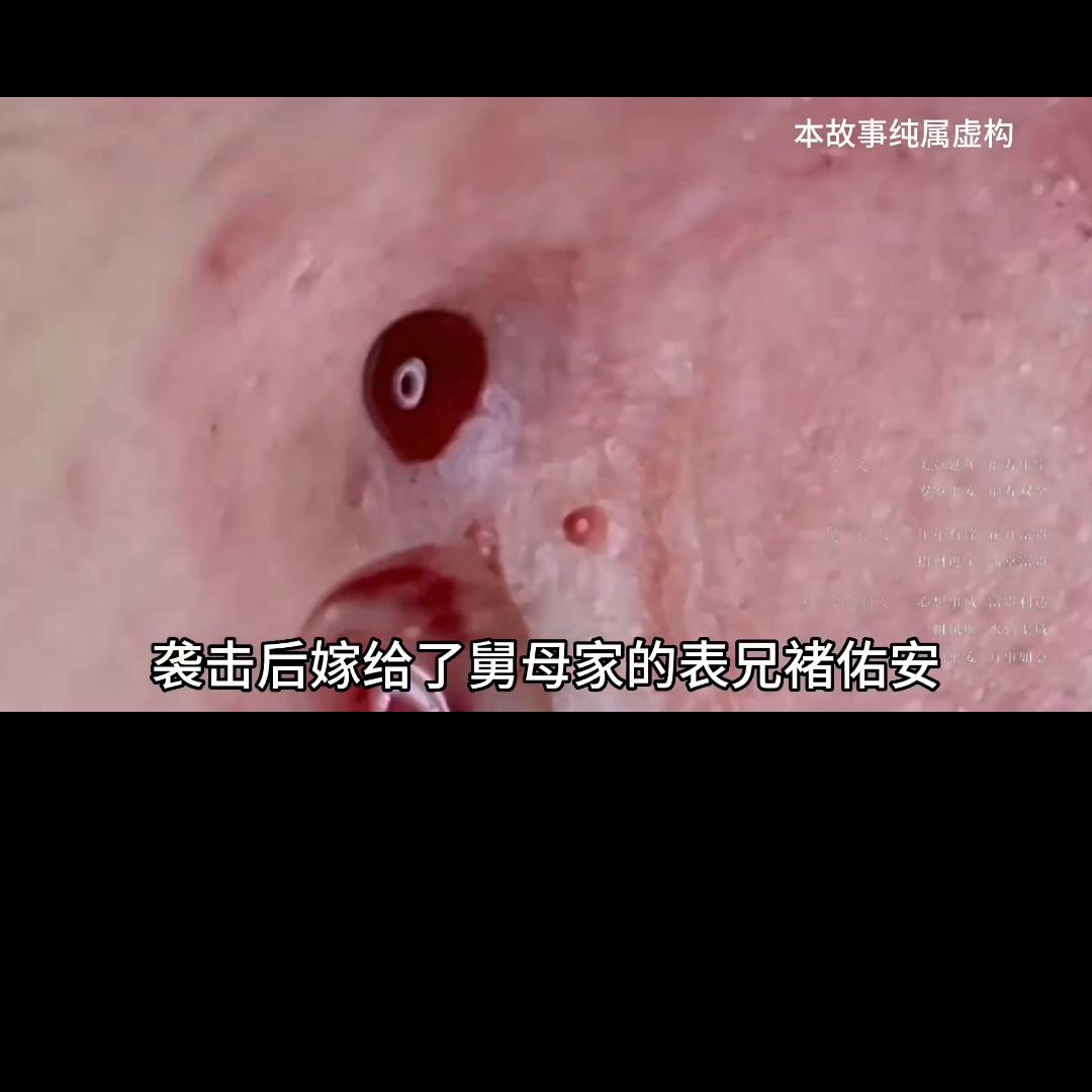 📖安安如招后续知乎#粉刺针的正确使用方法