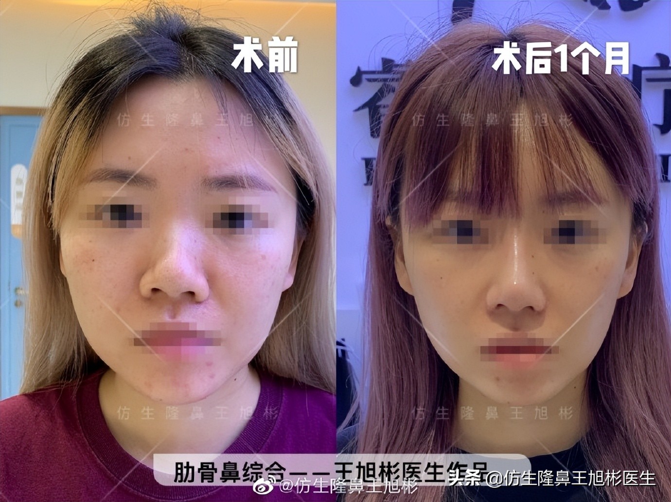 可以只做鼻头不放假体吗,只做鼻头鼻翼缩小手术多少钱