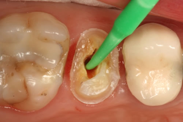 根管治疗后的牙齿看得出来吗,牙齿根管治疗后的牙齿能用多少年