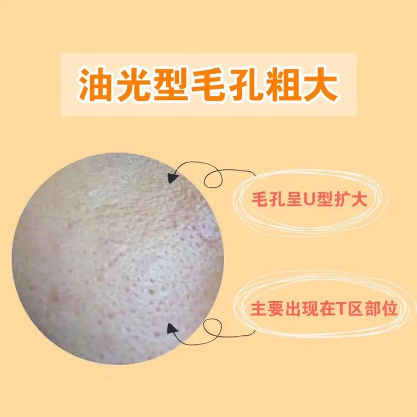 毛孔粗大的三大类型你属于哪一种,几种类型毛孔粗大改善的方法