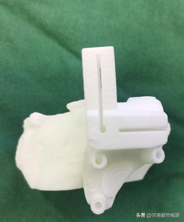 全球首例3d打印距骨表面假体置换,首例医生3d打印距骨表面植入人体