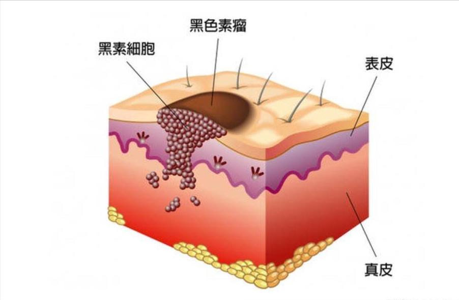 恶性黑色素痣癌变的前兆,黑色素痣癌变会有什么症状