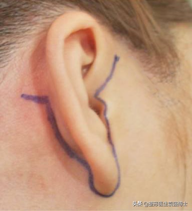 拉皮变美逆龄抗衰,拉皮逆龄抗衰