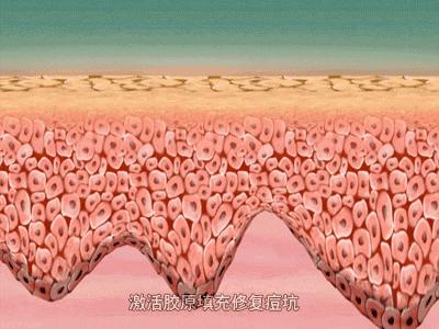 痘印开始变成痘坑了怎么办,痘印痘坑怎么修复最好的办法