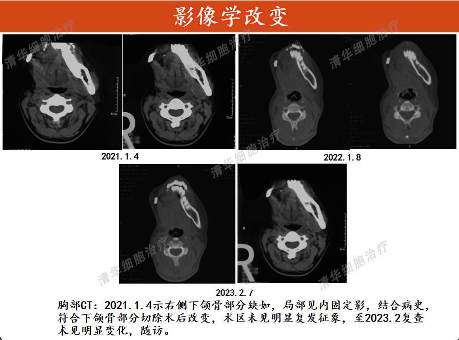 肉瘤领域的免疫疗法新策略,肉瘤免疫治疗的费用