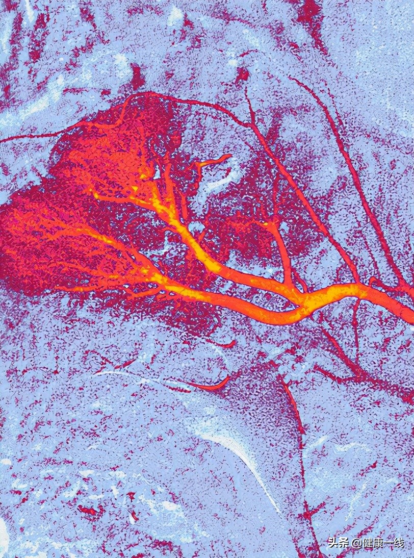 脉管炎预防方法,脉管炎最佳防治方法中药