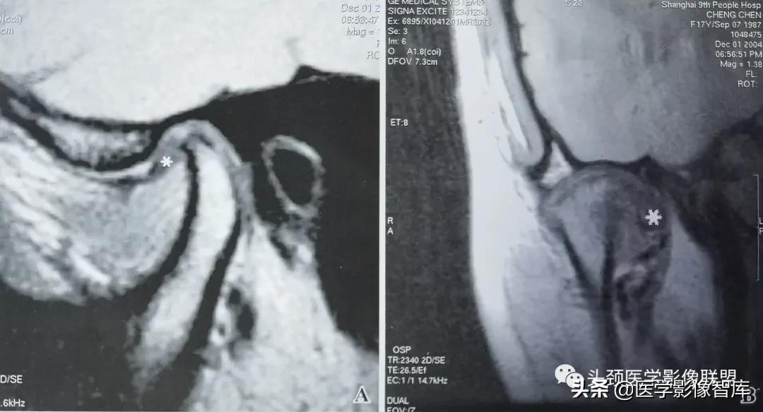 颞下颌关节移位怎么处理,颞下颌关节盘变形怎么治疗