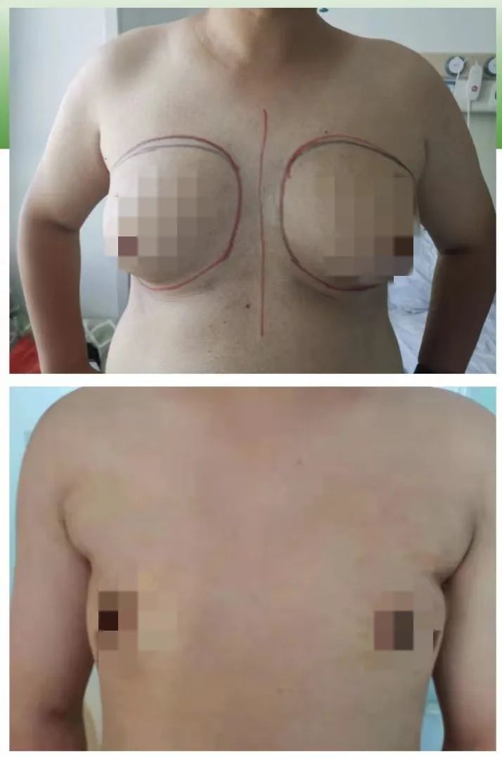 上海治疗男性乳房发育医院,高新区安泰医院