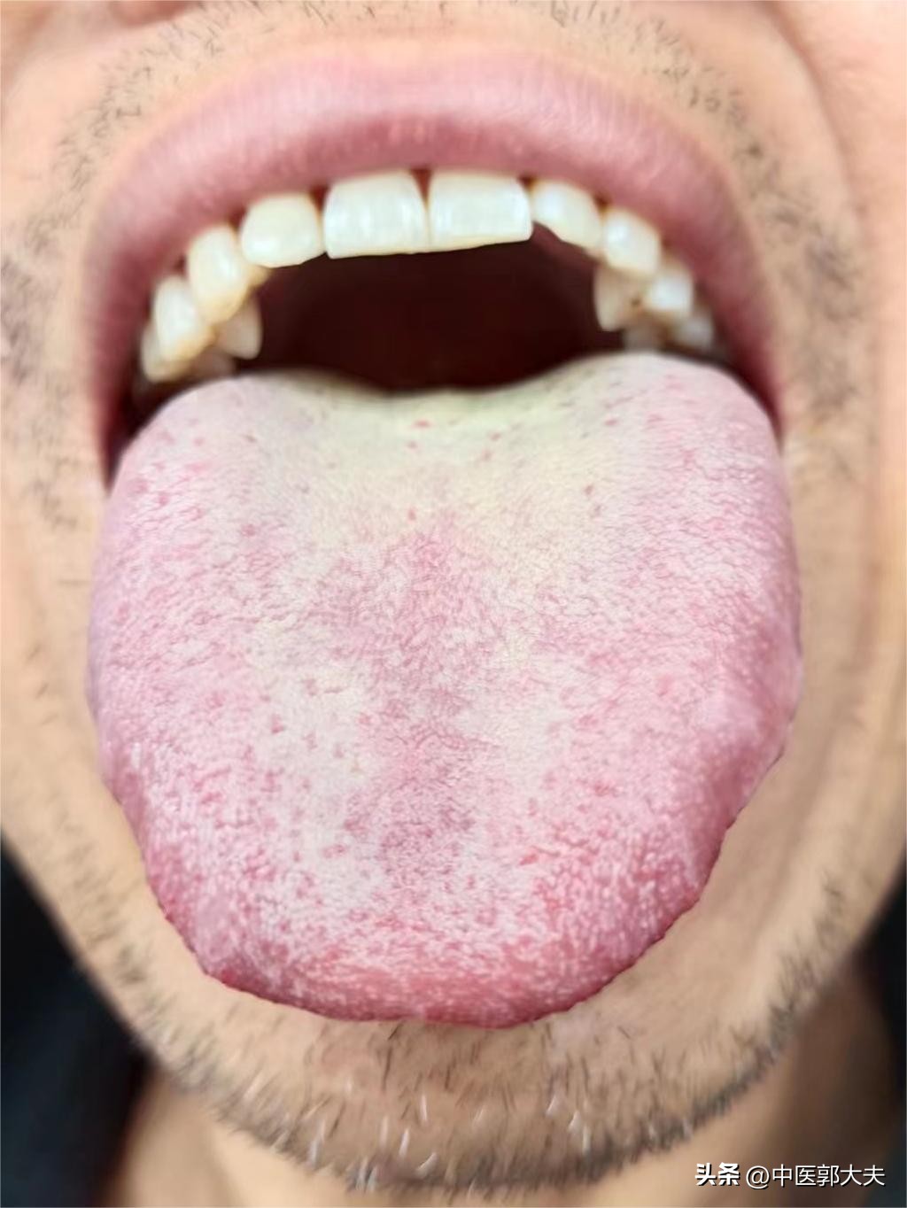 针对二阳最有效的中成药,二阳吃什么药最有效