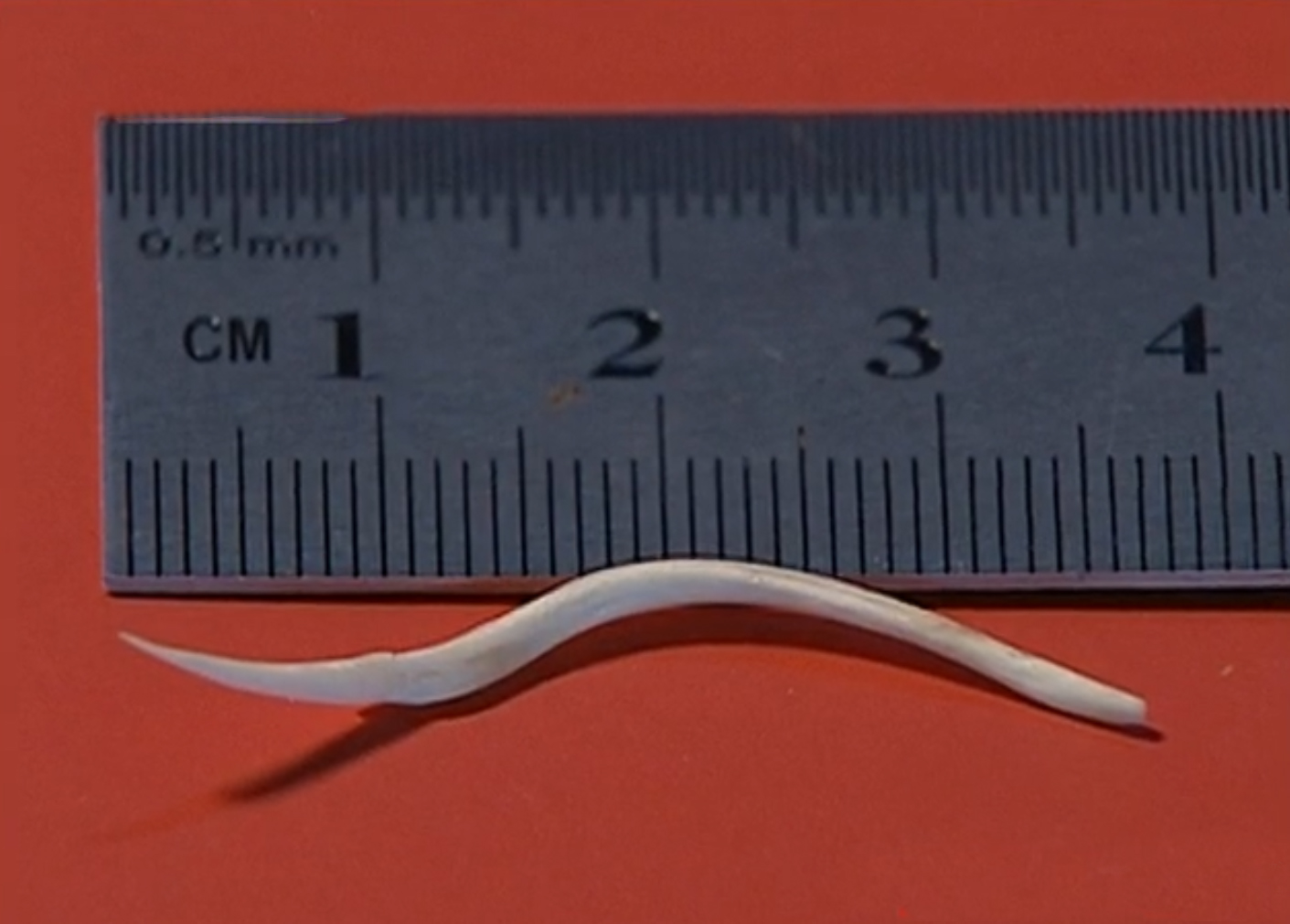 2010年,厦门小伙连续3月反复高烧,医生打开心脏夹出3厘米的鱼刺