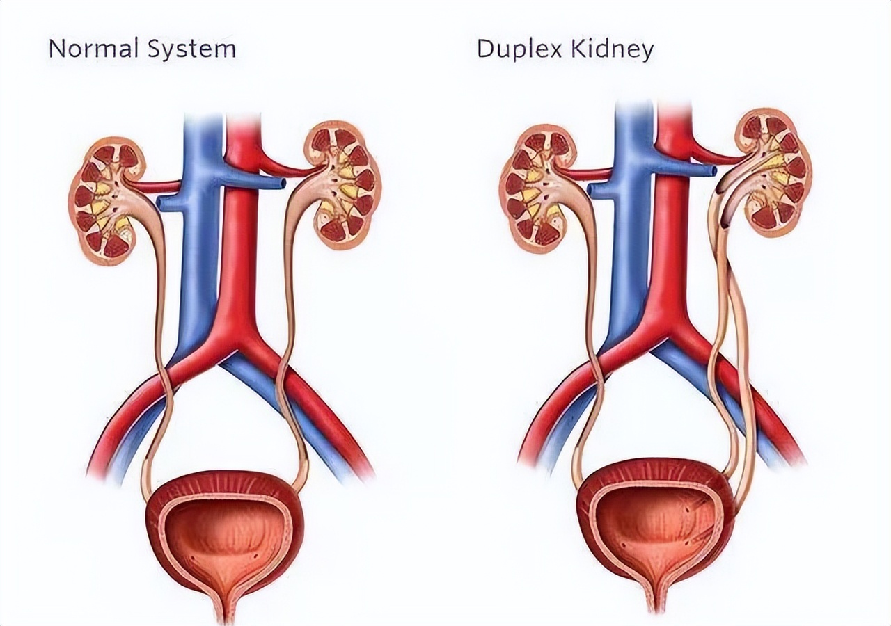 重复肾、重复输尿管是怎么回事？有哪些表现？需要手术吗？
