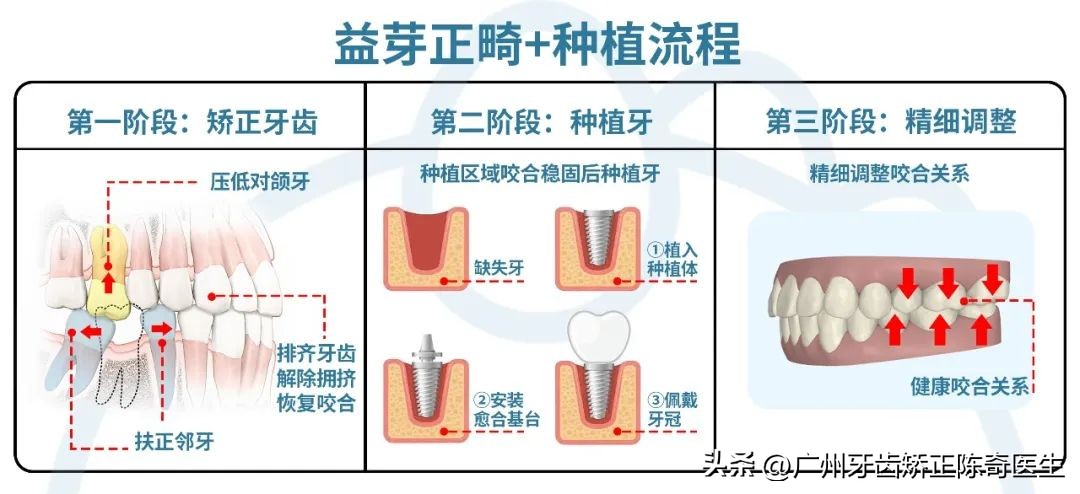 正畸治疗的基本矫治方法,正畸修复联合案例