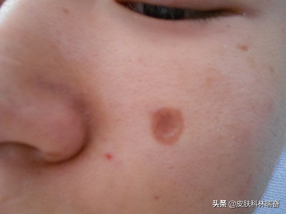 脸上点痣留下很明显的红印怎么办,脸上点痣后的疤痕怎么处理