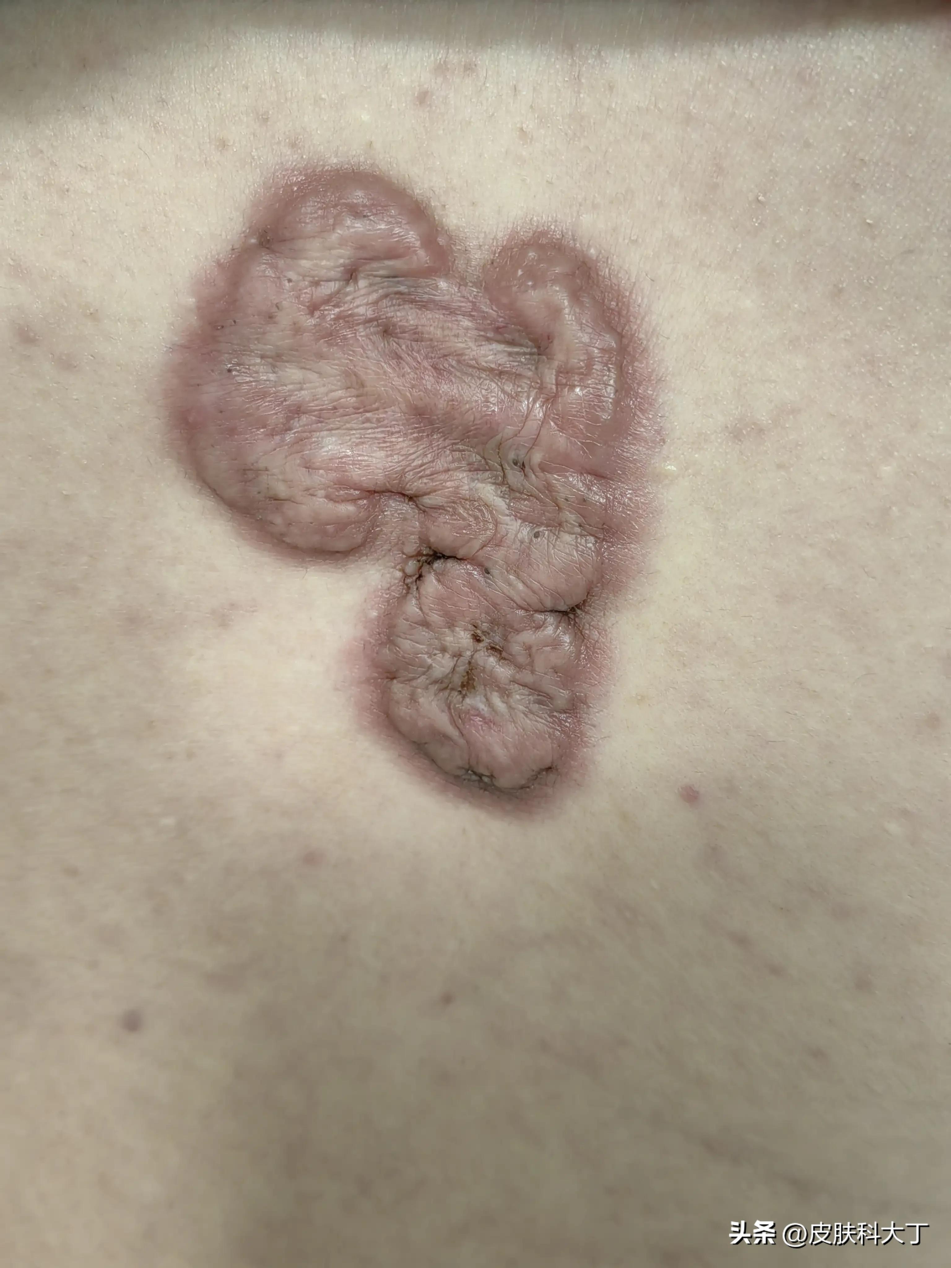 不要随便点痣的图片,不要轻易去痣