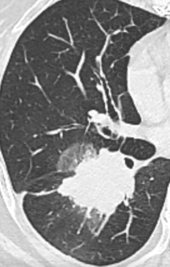 肺磨玻璃结节中药调理多久有效,肺磨玻璃结节中药可以治愈吗