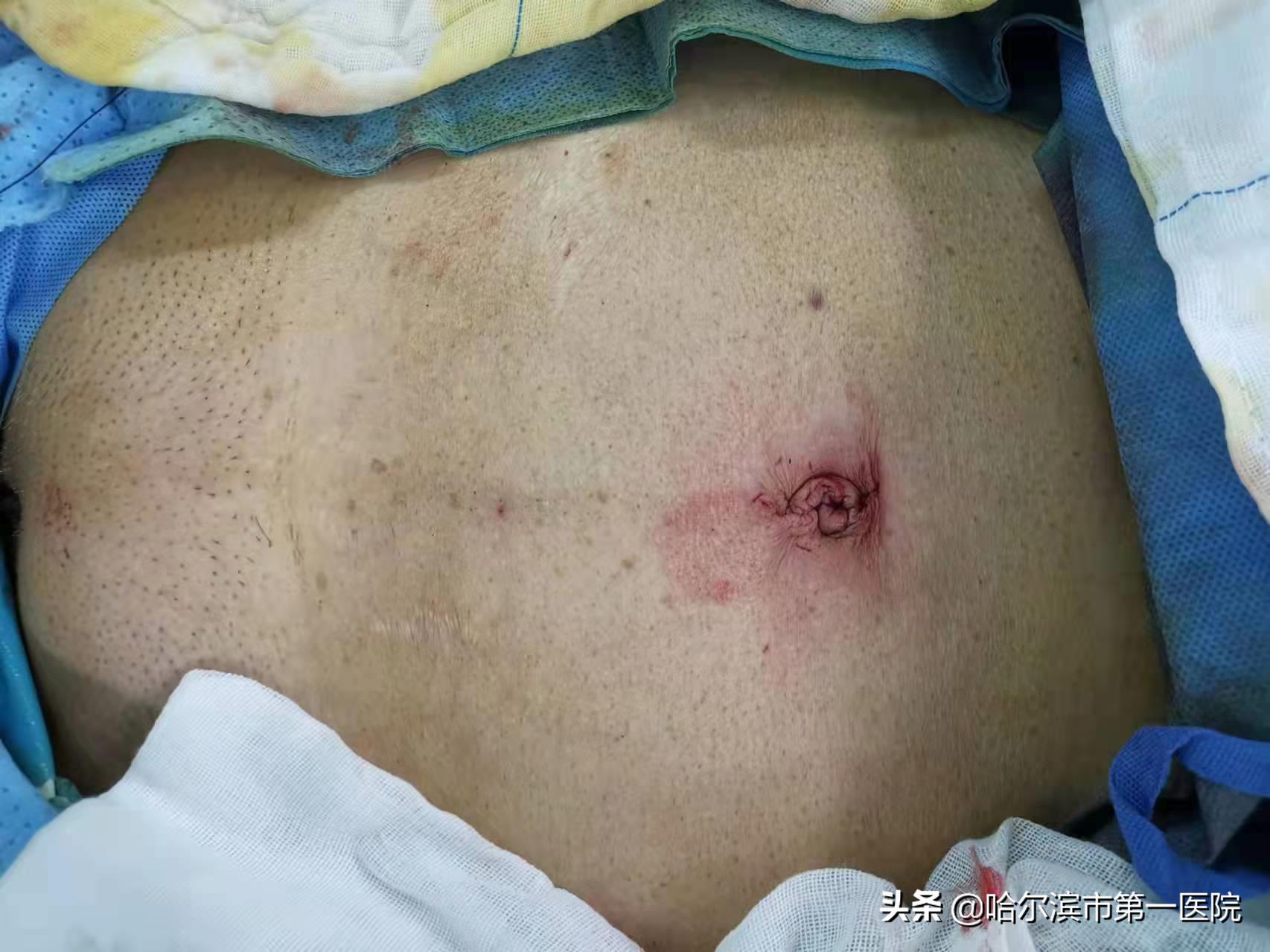 82岁老太肚子鼓包如足月孕妇原是“肿瘤”作怪—哈尔滨市第一医院妇二科利用“单孔腹腔镜”切除巨大卵巢肿瘤