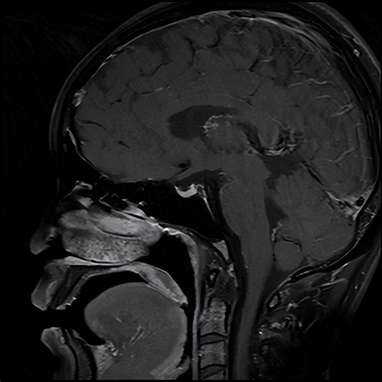 头晕乏力不简单，抽丝剥茧解谜团——粤桂两地医生联手揪出背后“元凶”