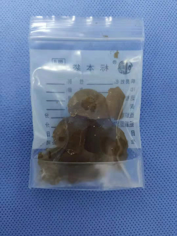 男孩腹胀如鼓,患儿男1岁腹痛哭闹呕吐