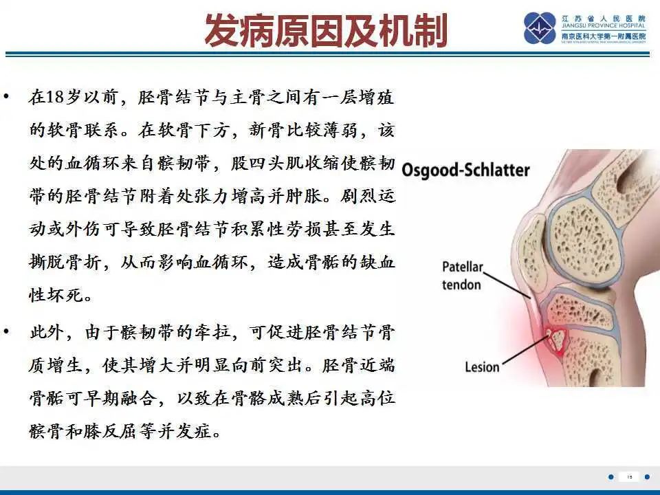 胫骨结节软骨炎要怎么治疗,胫骨结节骨软骨炎会癌变吗