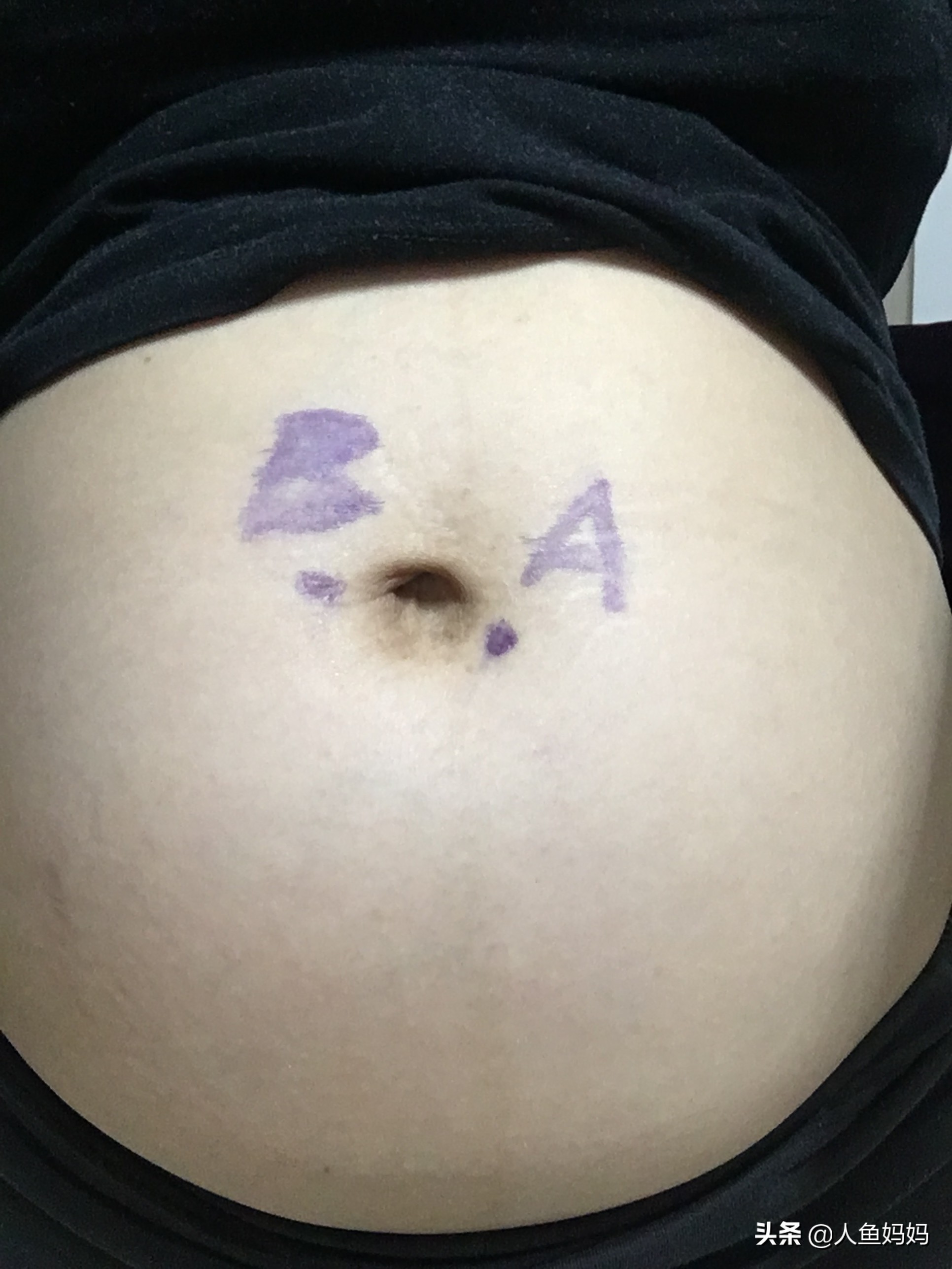 孕妇双胞胎做羊膜穿刺,怀双胞胎产检全过程