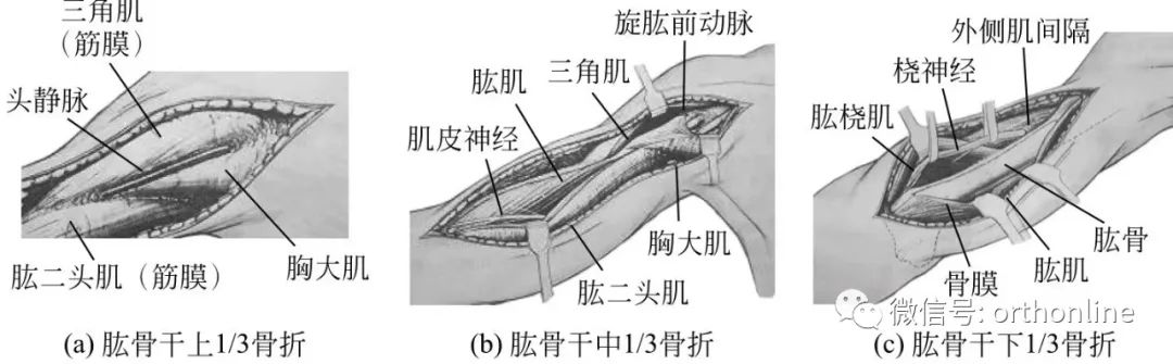 肱骨干骨折髓内钉手术记录,肱骨干骨折康复训练全套视频