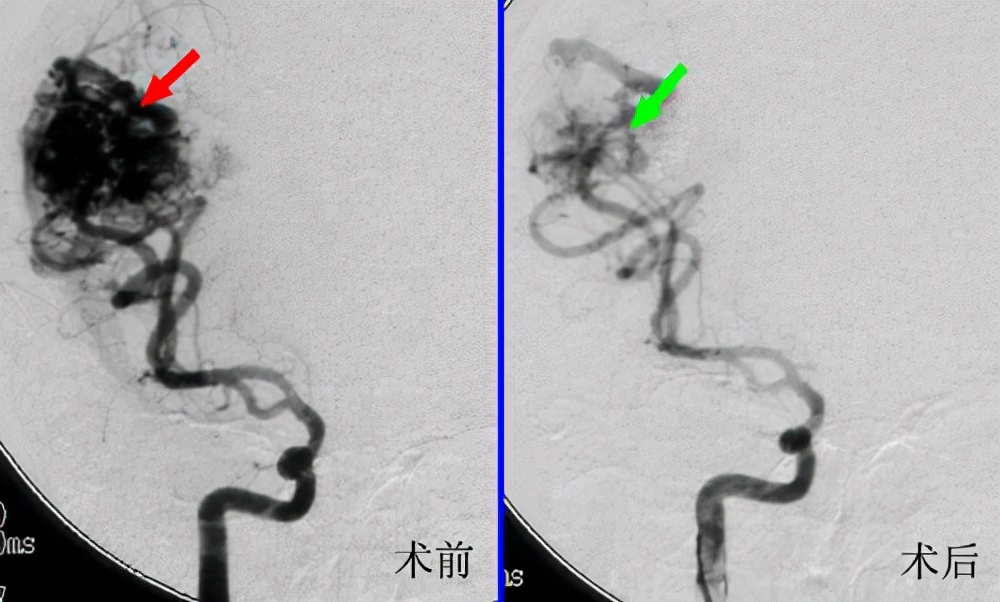 静脉血管畸形介入治疗,治疗动静脉血管畸形哪家医院最强