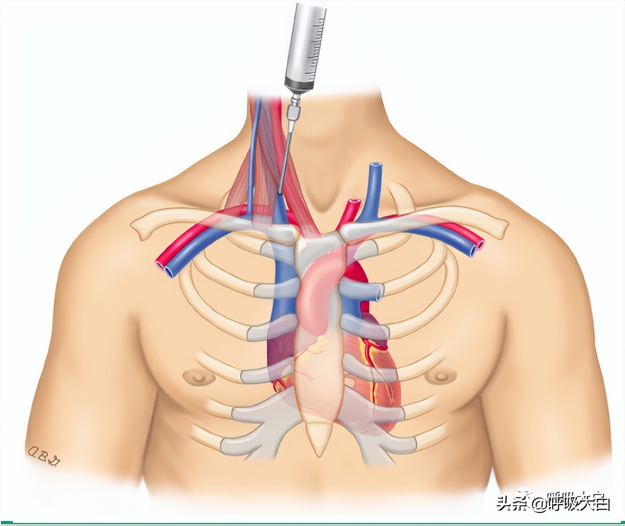 中心静脉导管置入术的步骤,颈内静脉导管拔除注意事项