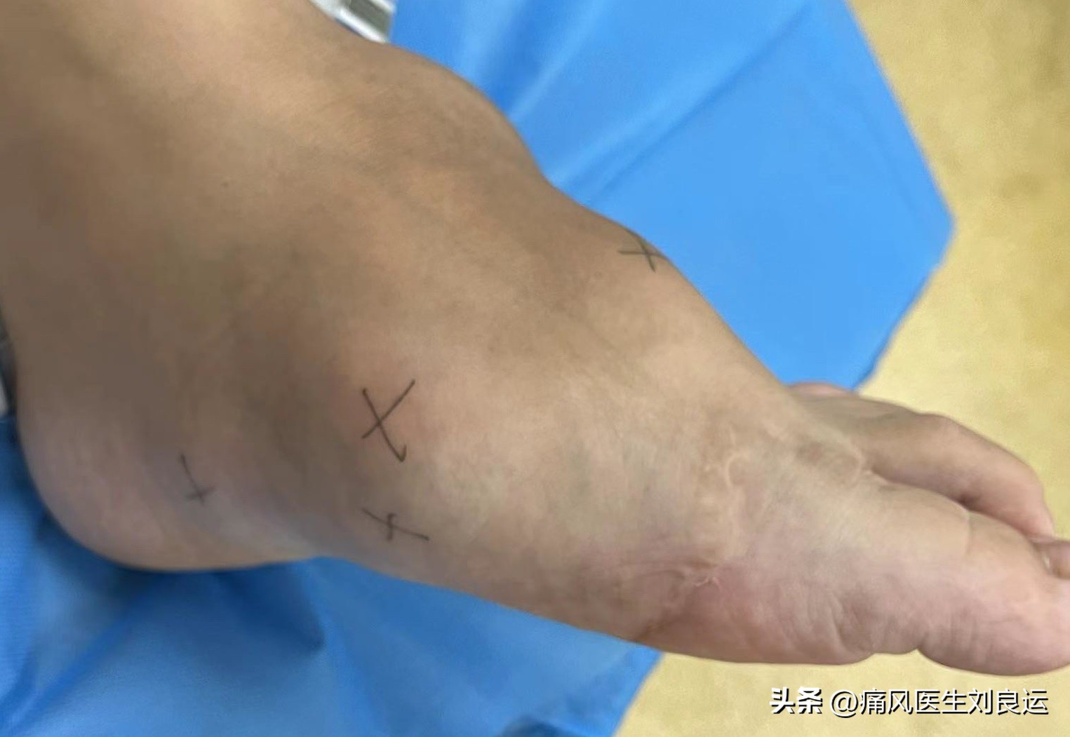 治疗痛风需要达标治疗，什么是痛风的达标治疗？从三方面做好管理