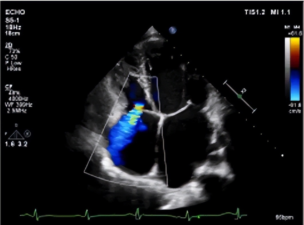 深圳龙华哪个医院治疗心梗,脑梗心梗深圳医院最好