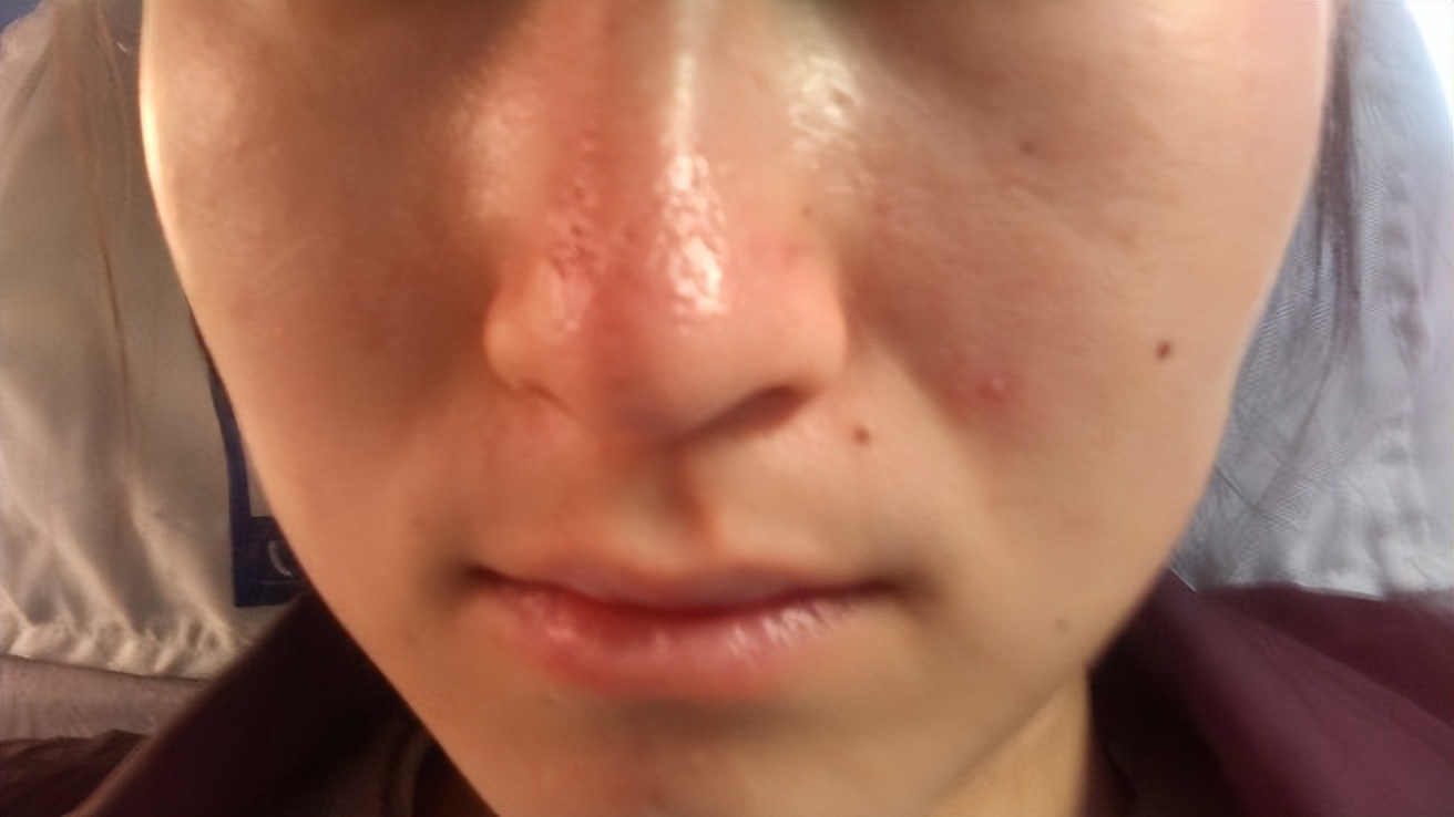 鼻子毛孔大能挤出好多脂肪粒,鼻子上长了像脂肪粒的东西