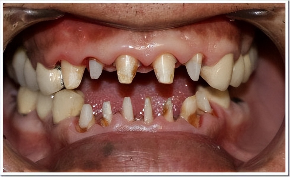 戴假牙套的牙活动了怎么办,假牙套的危害有哪些