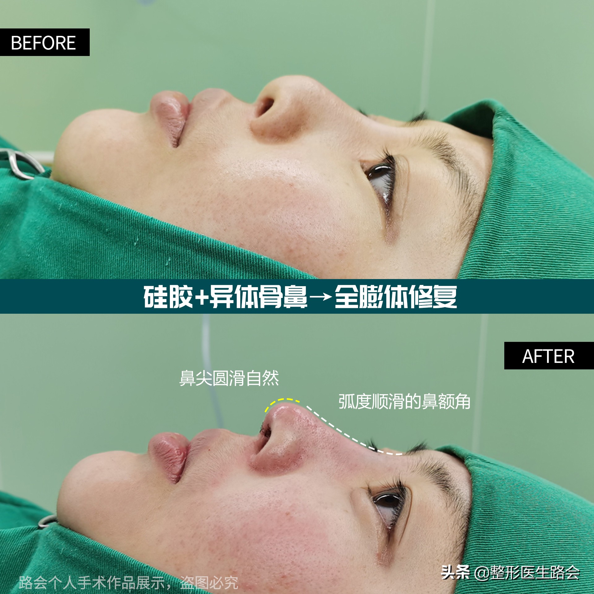 隆鼻失败鼻头有个坑的原因,隆鼻失败导致的鼻头凹陷怎么修复