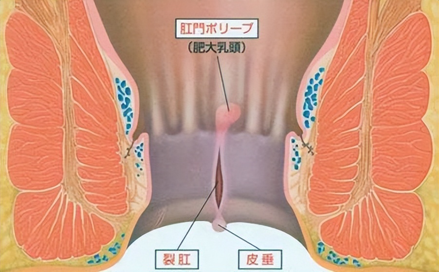 引起肛裂最常见的原因,女性易患肛裂的原因是什么