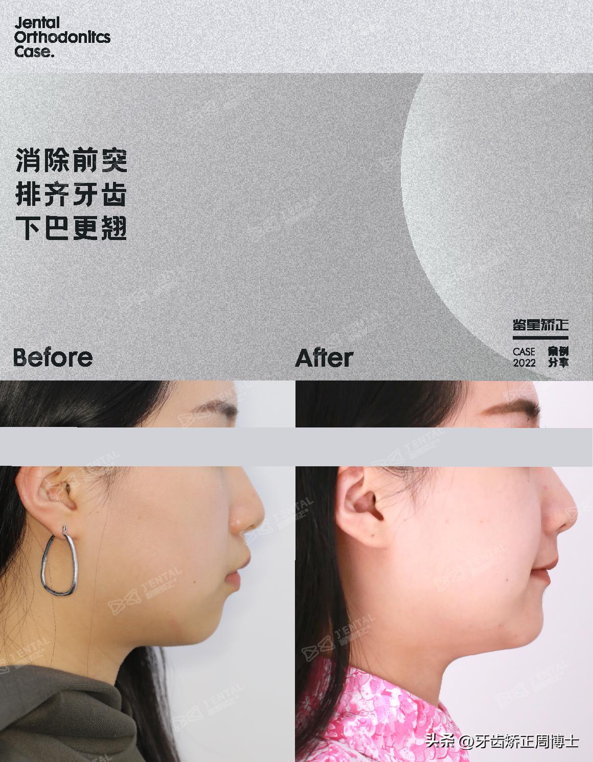 即刻种植即刻修复免受缺牙的痛苦,缺牙不补倾斜矫正价钱