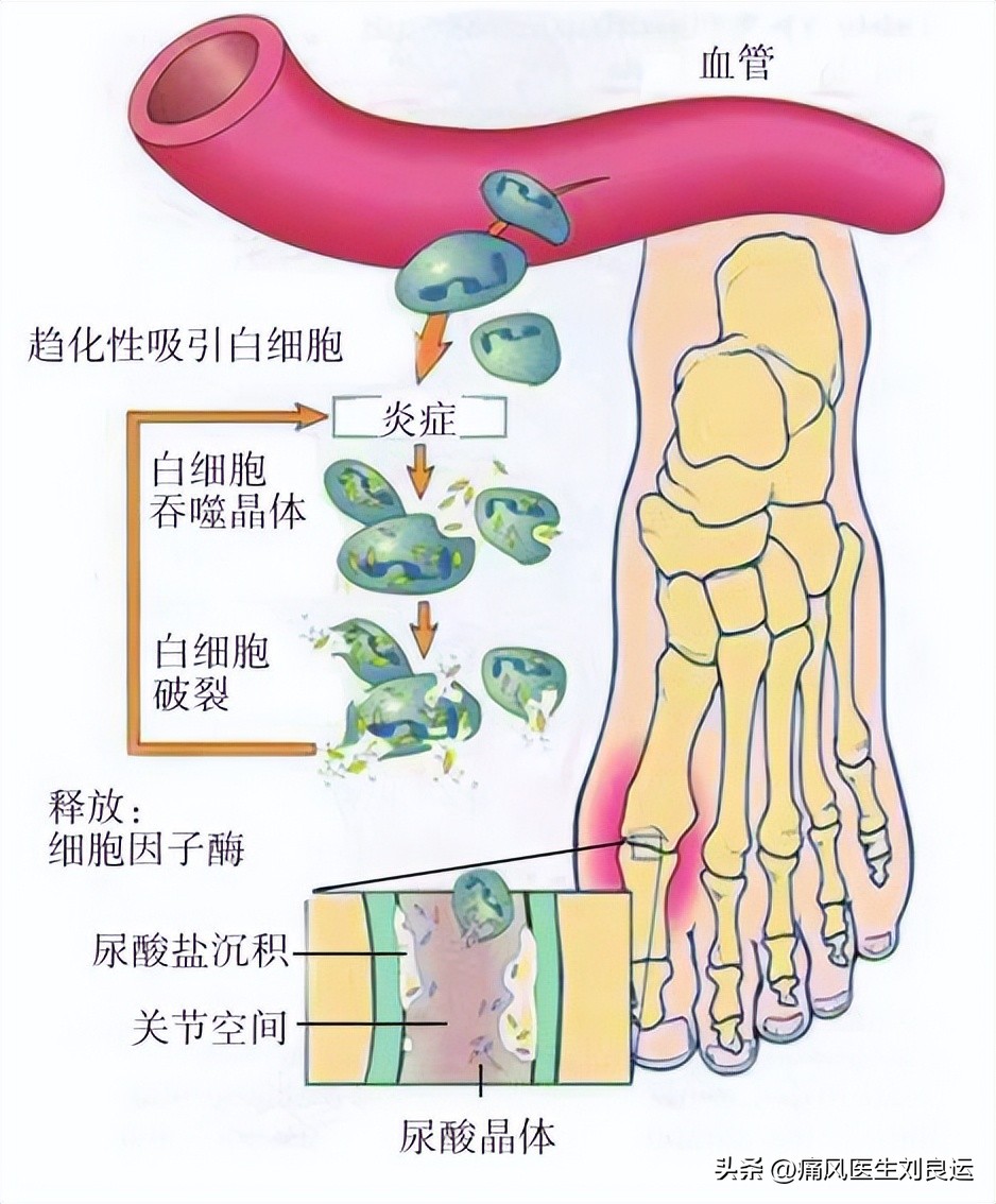 降尿酸消痛风用药方式,痛风发作医生强降尿酸
