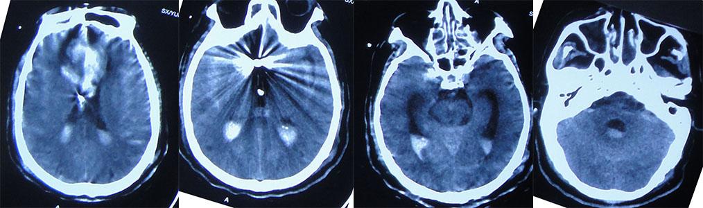 前交通动脉瘤破裂后开颅治疗风险,脑前交通动脉瘤破裂出血