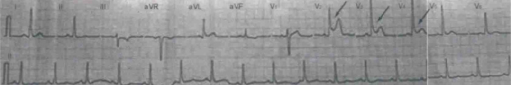 急诊PCI指南,急诊pci治疗费用