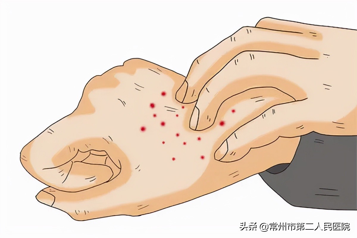 手脚发痒难受长红疙瘩特别是晚上,一到晚上手脚就痒用什么药