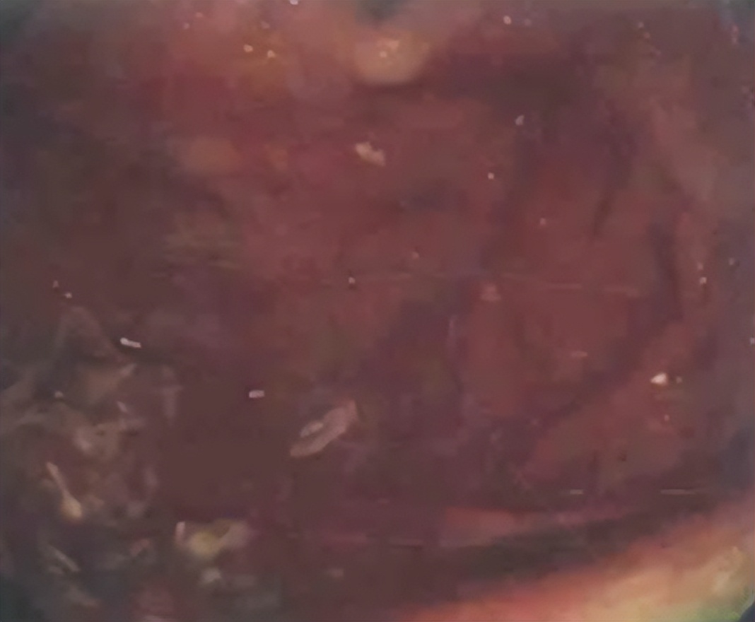 急诊PCI指南,急诊pci治疗费用