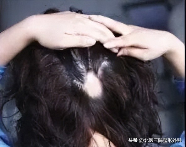 三种方法治疗头皮疤痕,头皮疤痕用什么淡化