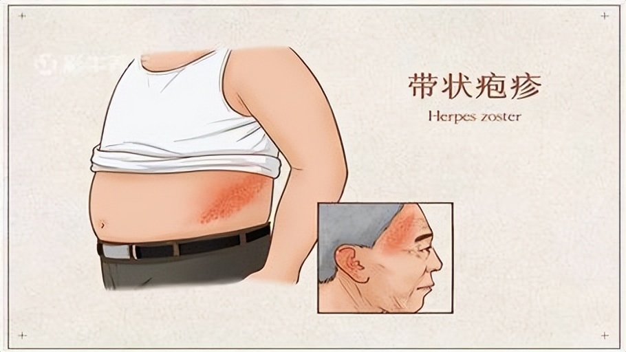 皮肤癣摸一下会传染么,顽固皮肤癣会传染吗