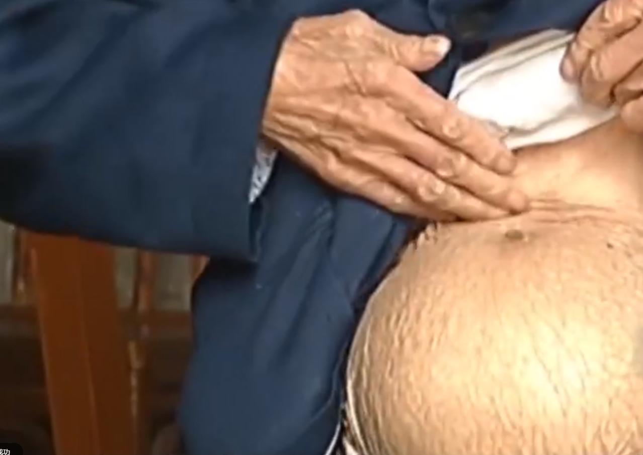 2007年四川90岁老妇，腹中怀子60年未生，后检查发现胎儿没有腐烂